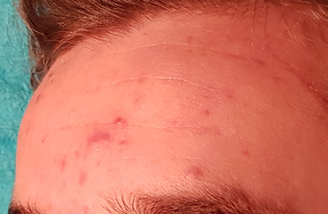 Acnetherapie