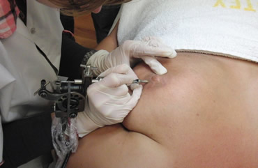 Dermatografie